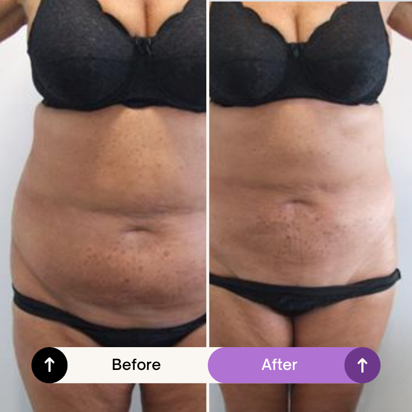 MORAH™ Revive+ Slimming Belt